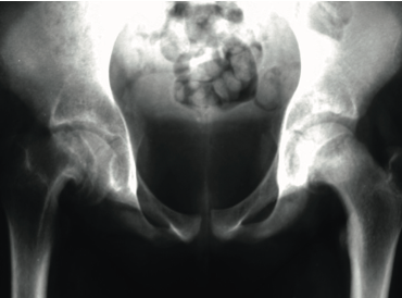 Osteochondrite Epiphysiolyse Osteochondrose Etc La Hanche Dans Tous Ses Etats Pediatrie Pratique