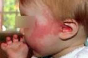 Cela Ressemble A De L Allergie Alimentaire Mais Ce N Est Pas De L Allergie Alimentaire Pediatrie Pratique